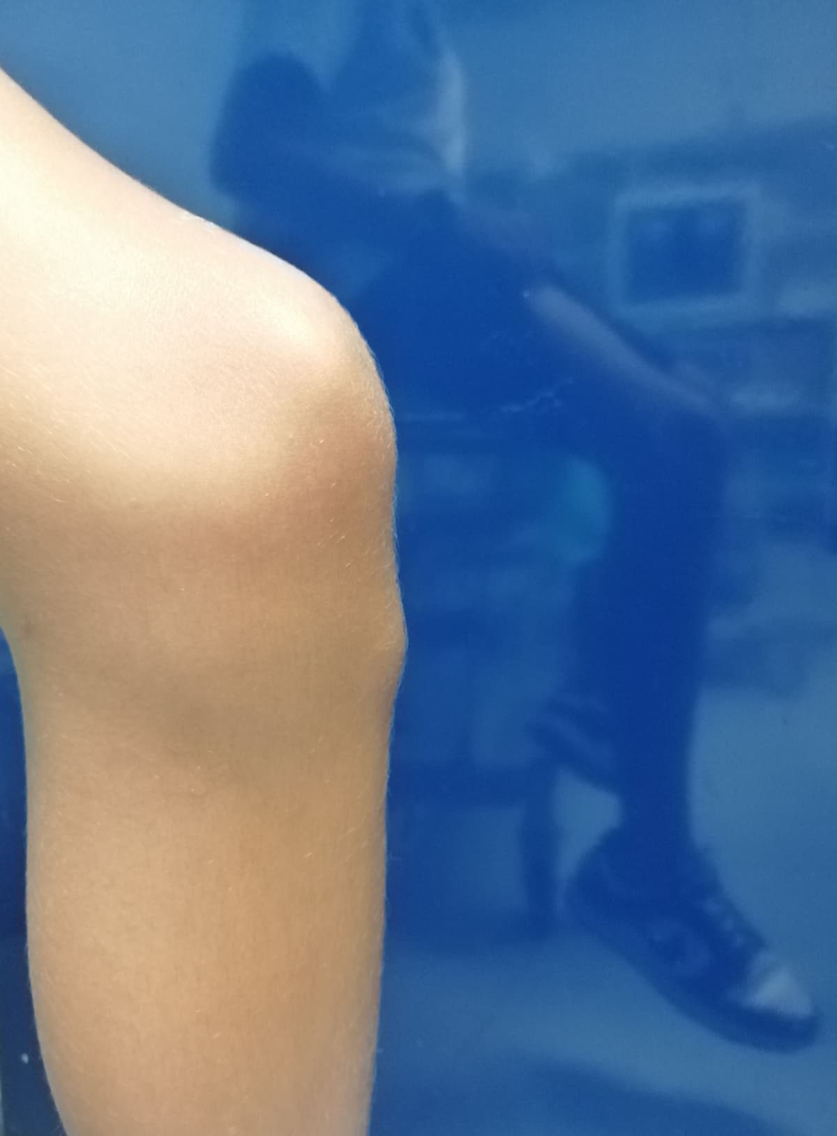 Osgood-Schlatter disease – swelling on the knee, image 1