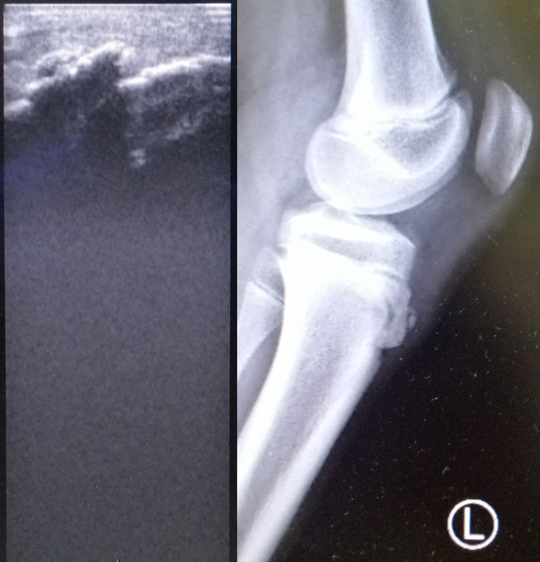 Osgood-Schlatter disease – X-ray showing an ossicle, image 2
